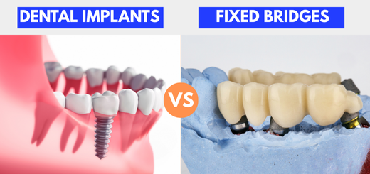 Dental Implants Versus Fixed Bridges